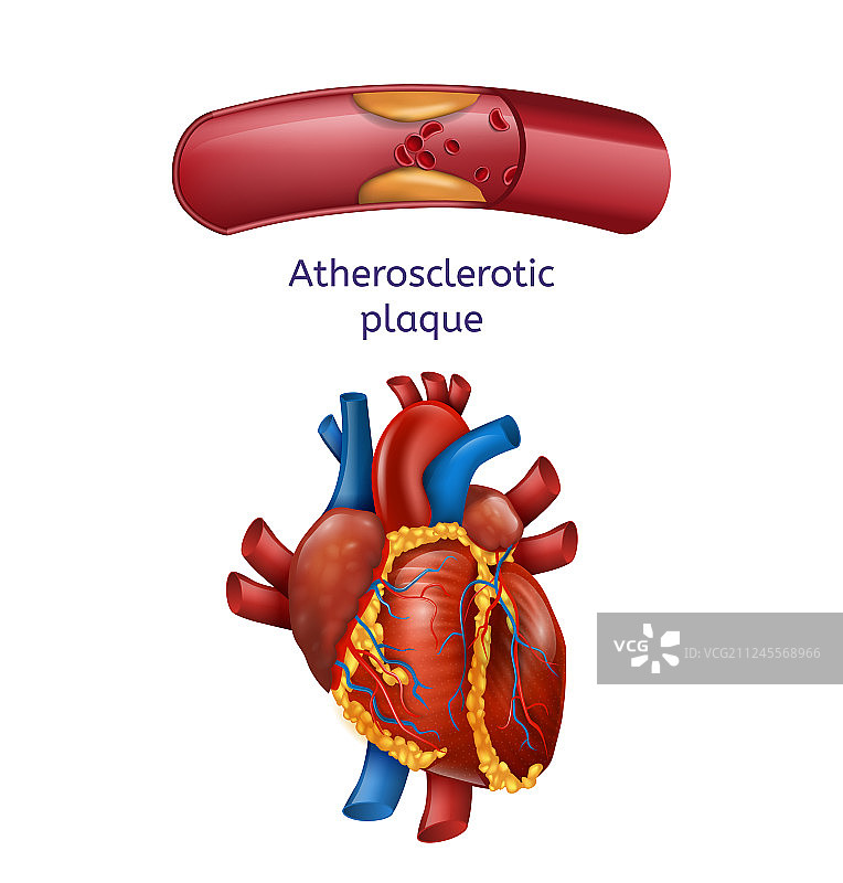 医疗横幅：心脏和阻塞血管特写图片素材