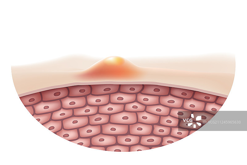 痤疮肌肤图片素材