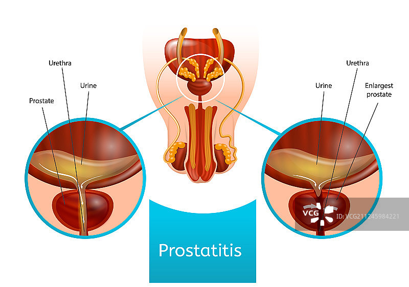 前列腺炎男性生殖系统示意图图片素材
