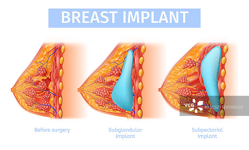 女性隆胸植入医疗banner图片素材