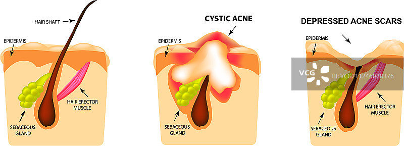 粉刺发炎囊肿图片素材