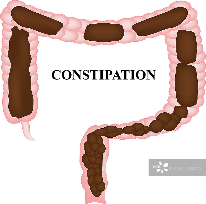 结肠内便秘粪便信息图图片素材