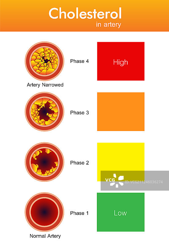 胆固醇在动脉健康风险设计中的作用图片素材