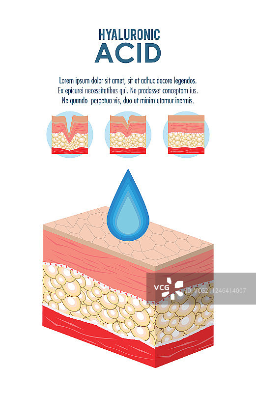 透明质酸填充剂注射信息图图片素材