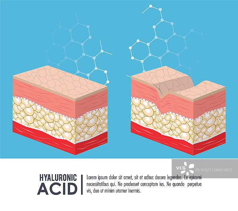 透明质酸填充剂注射信息图图片素材