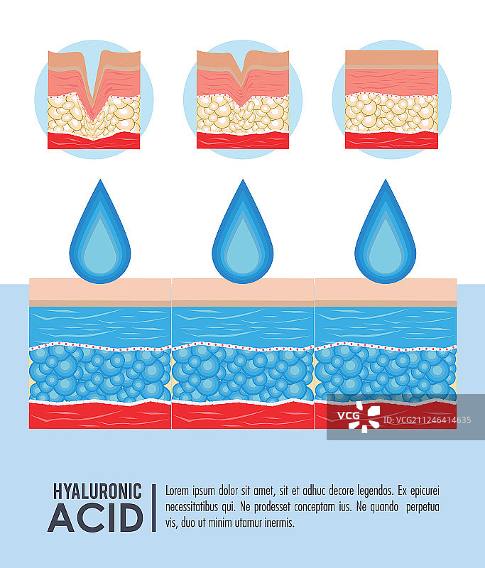 透明质酸填充剂注射信息图图片素材