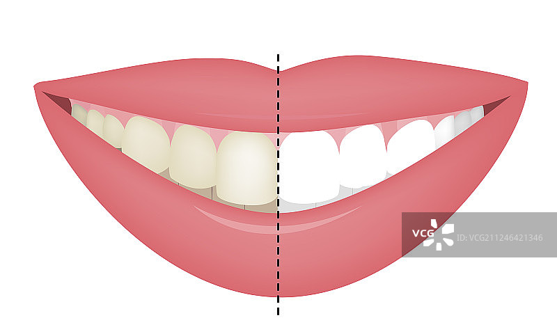 牙齿美白前后对比图片素材