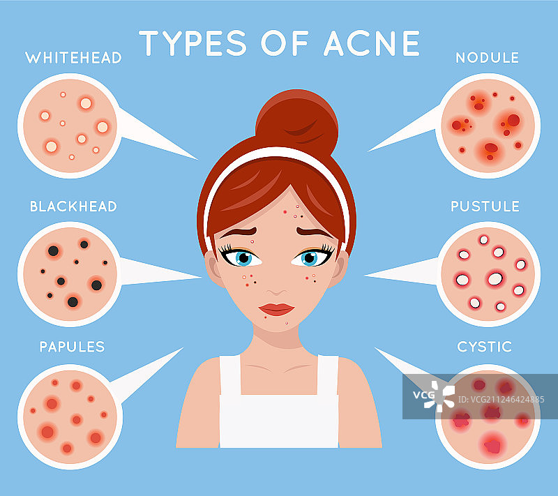 女性面部痤疮皮肤护理问题图片素材