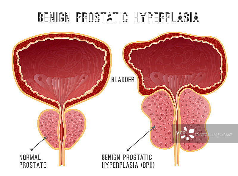 前列腺疾病信息图图片素材