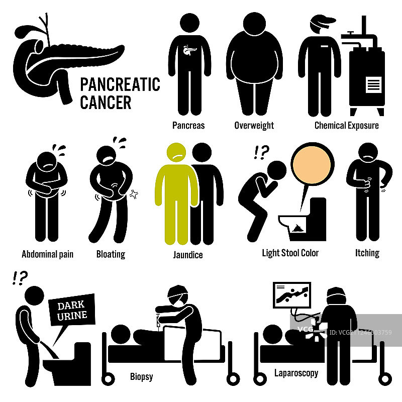 胰腺癌症状病因风险图片素材