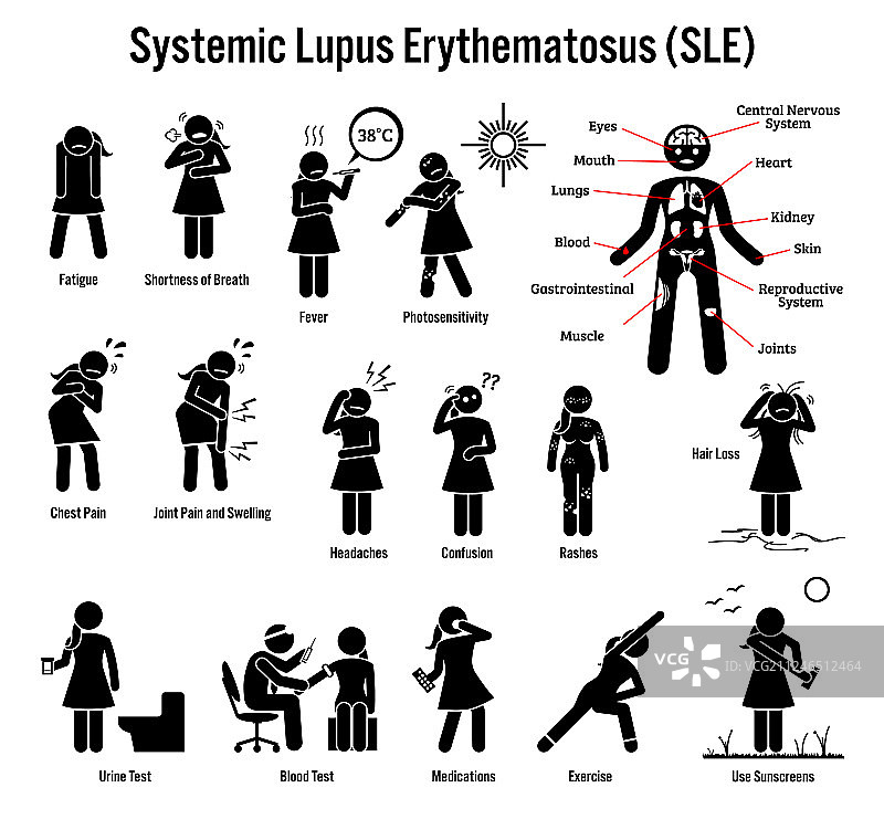 系统性红斑狼疮SLE自身免疫图片素材