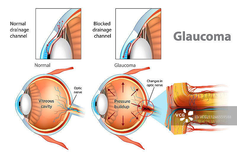 显示开角型青光眼图片素材