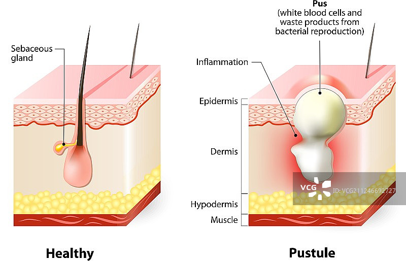 痤疮粉刺类型图片素材