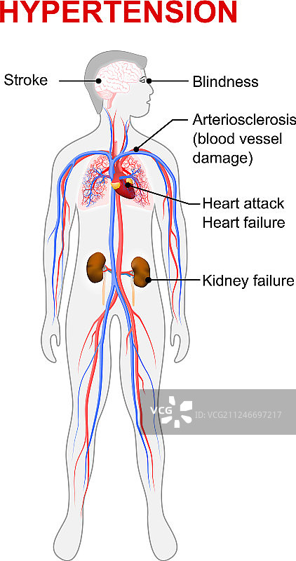 高血压图片素材