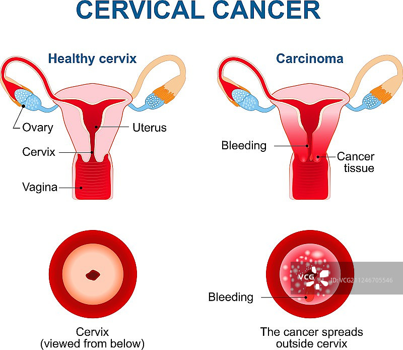 宫颈癌图片素材
