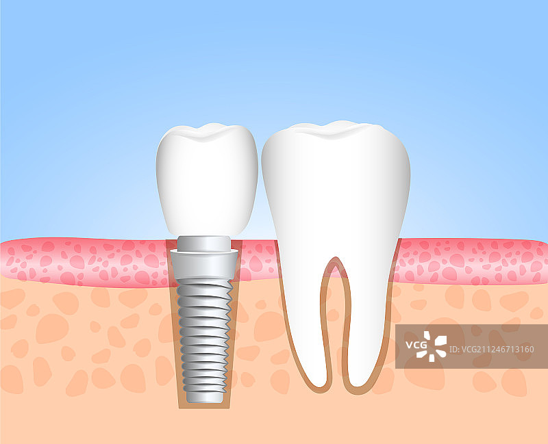 牙科植入修复体图片素材