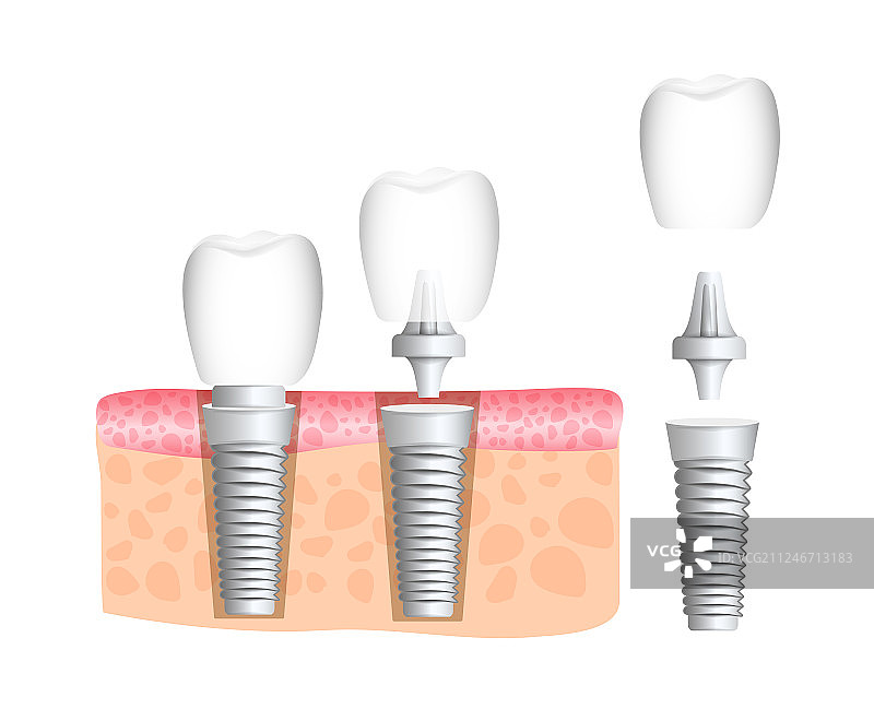 牙科植入修复体图片素材