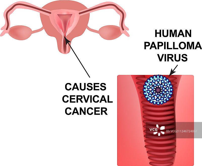 人乳头瘤病毒引起宫颈癌图片素材