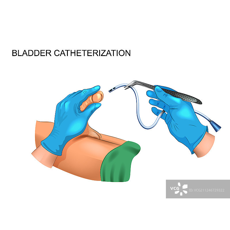 男性膀胱导管插入术图片素材