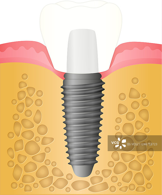 牙科植入体图片素材