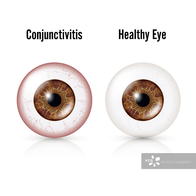 结膜炎红眼与健康眼睛图片素材