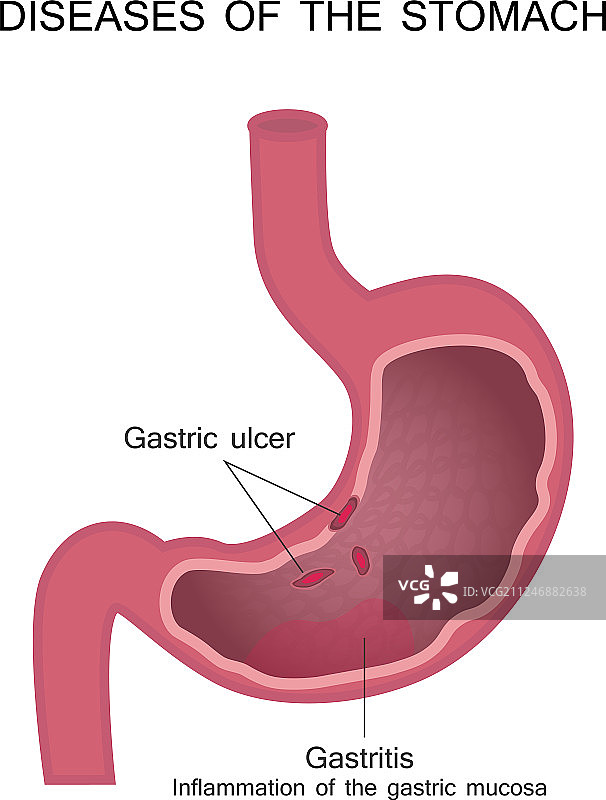 胃部疾病：消化性溃疡图片素材