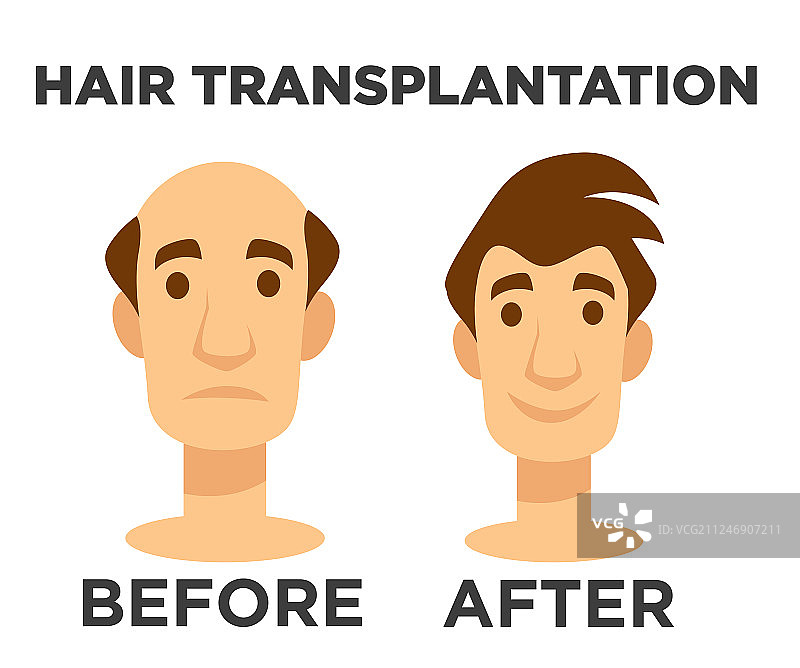 头发移植前后效果，秃顶图片素材