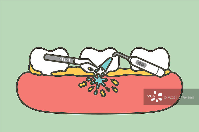 牙齿洁治——清除牙菌斑以进行清洁图片素材
