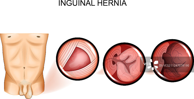 腹股沟疝嵌顿图片素材