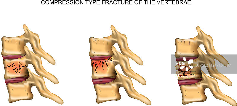 脊椎压缩性骨折图片素材
