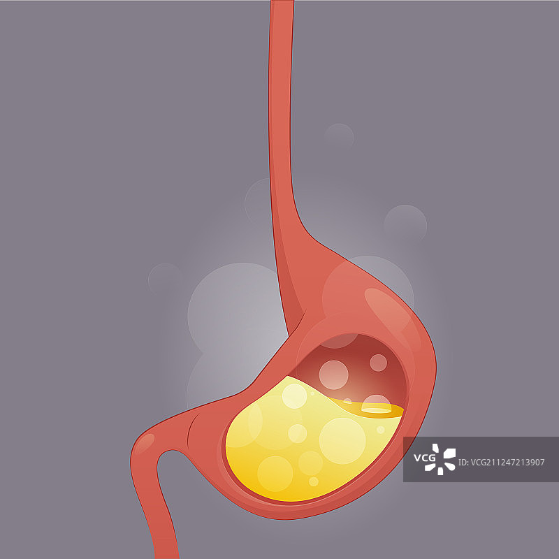 胃食管反流疾病图片素材