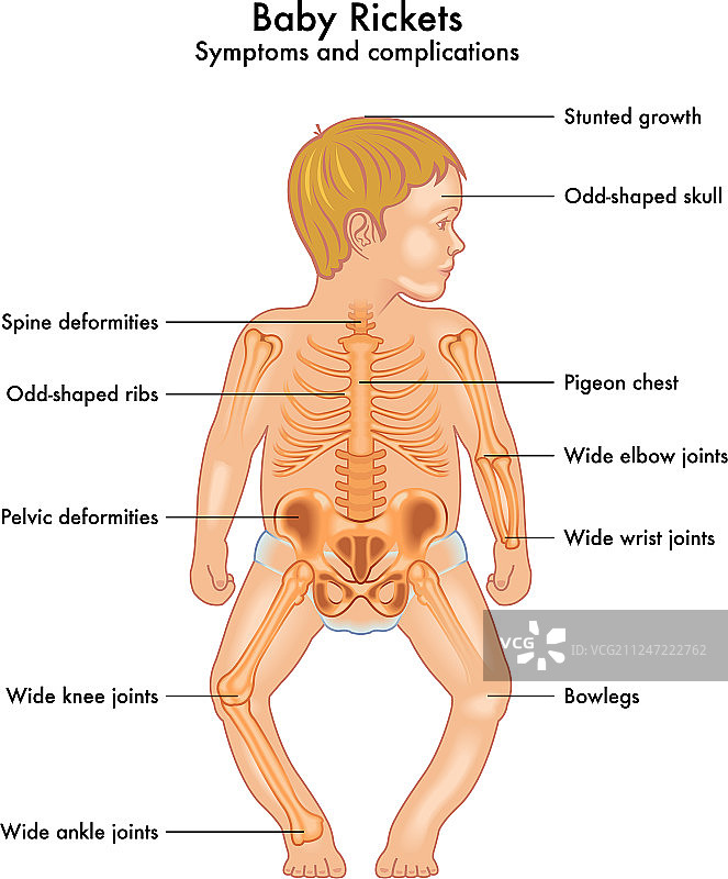 佝偻病症状图片素材