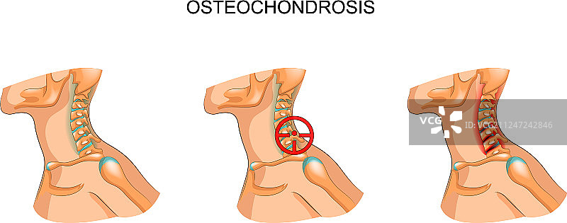 颈椎骨软骨病图片素材
