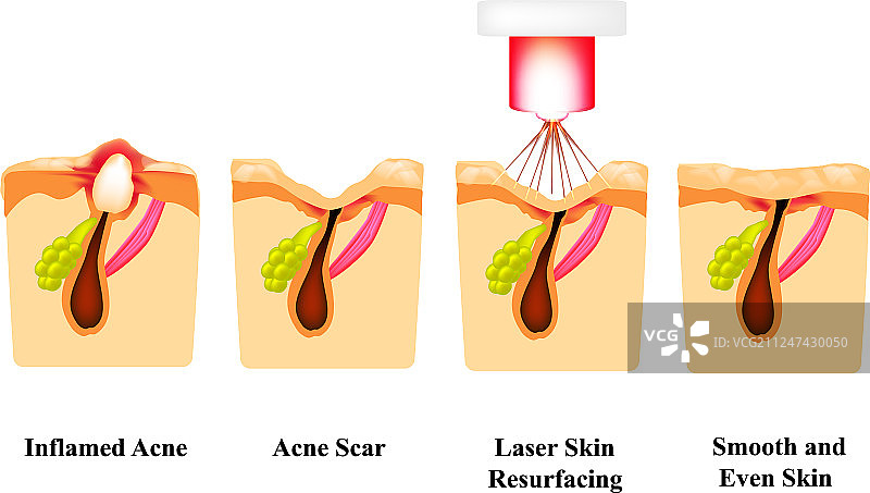 皮肤上的炎症痤疮粉刺图片素材
