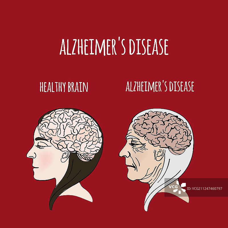 阿尔茨海默病痴呆症医学图片素材