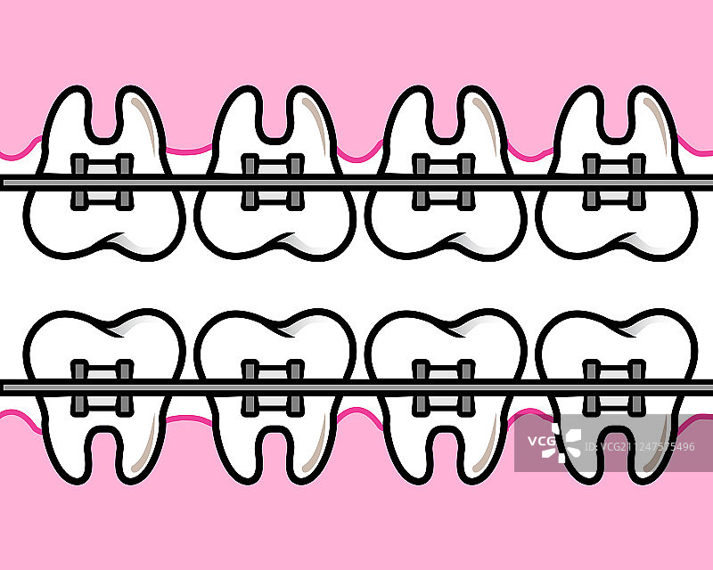 带牙套的牙齿图片素材