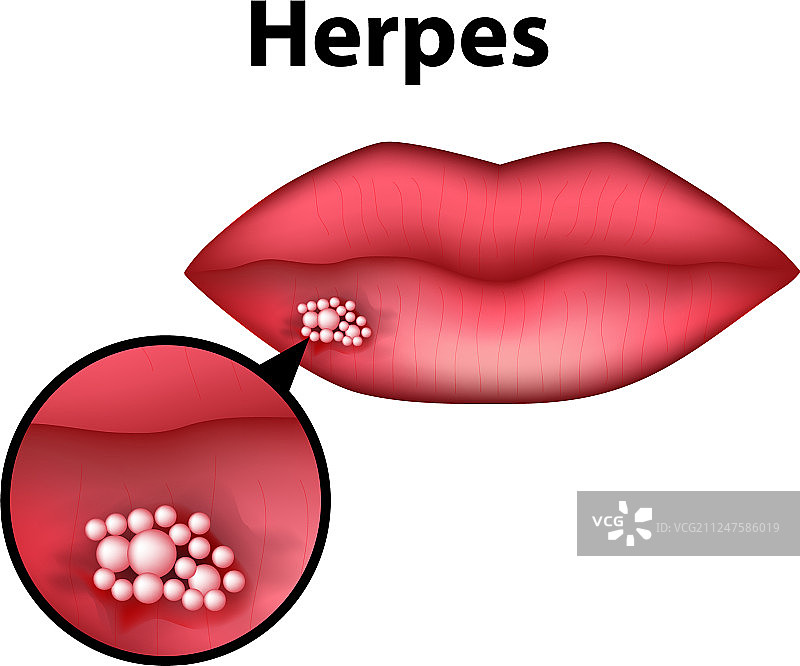 唇疱疹信息图图片素材