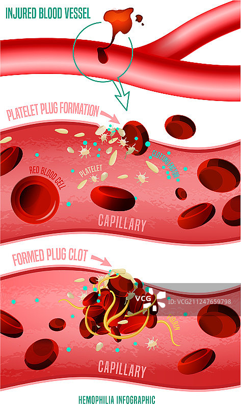 血栓形成图片素材