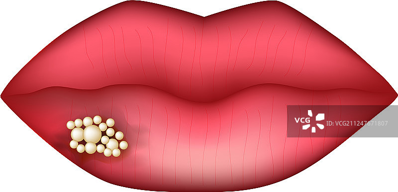 唇疱疹信息图图片素材