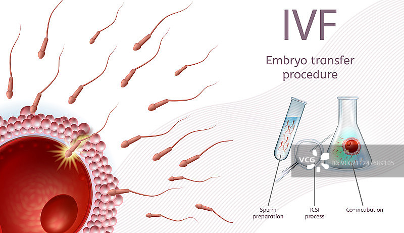 体外受精胚胎移植过程图片素材
