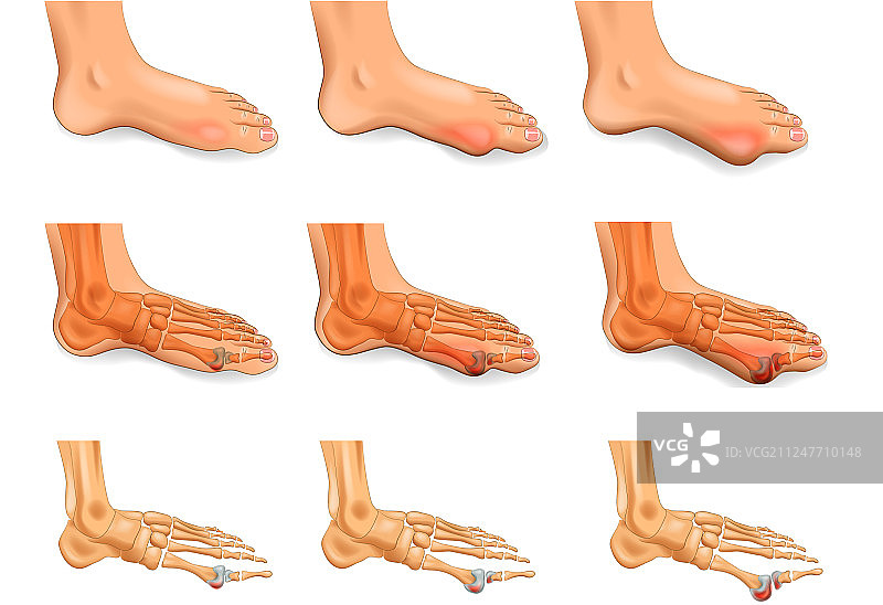 大脚趾关节炎图片素材