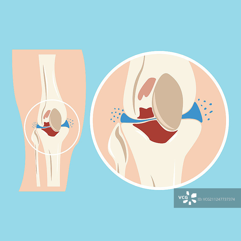 受损的人类膝关节软骨损伤图片素材