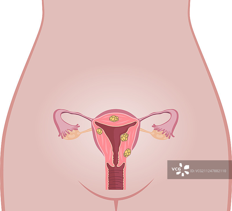子宫肌瘤解剖结构图片素材