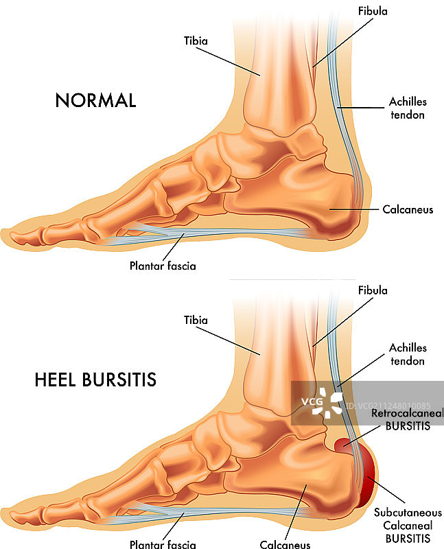 跟腱滑囊炎图片素材