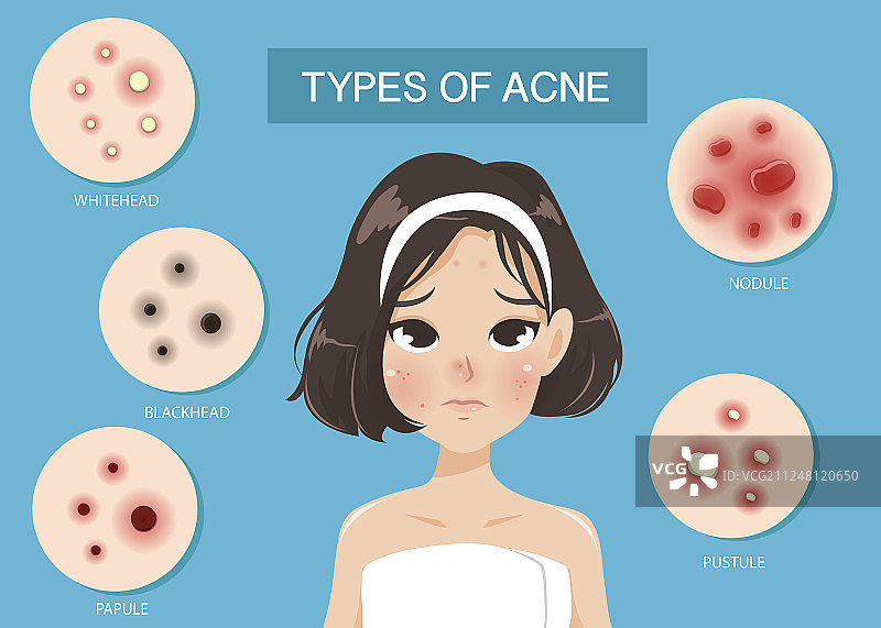 痤疮类型图片素材