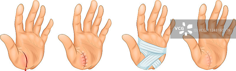 手部割伤图片素材