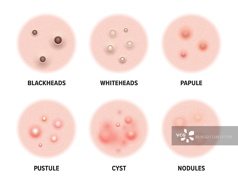 皮肤痤疮类型图图片素材