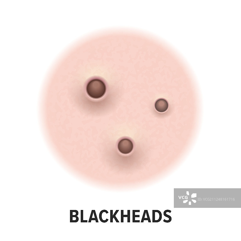 黑头粉刺皮肤问题图标图片素材