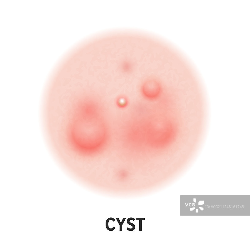 囊肿皮肤痤疮类型图标图片素材