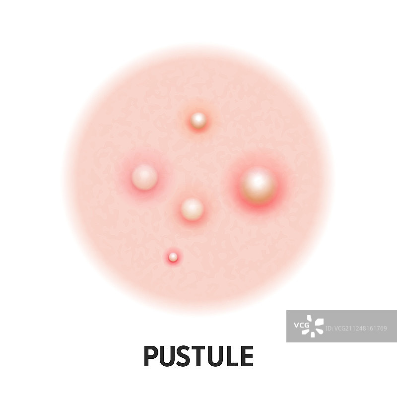 脓疱痤疮皮肤问题图标图片素材